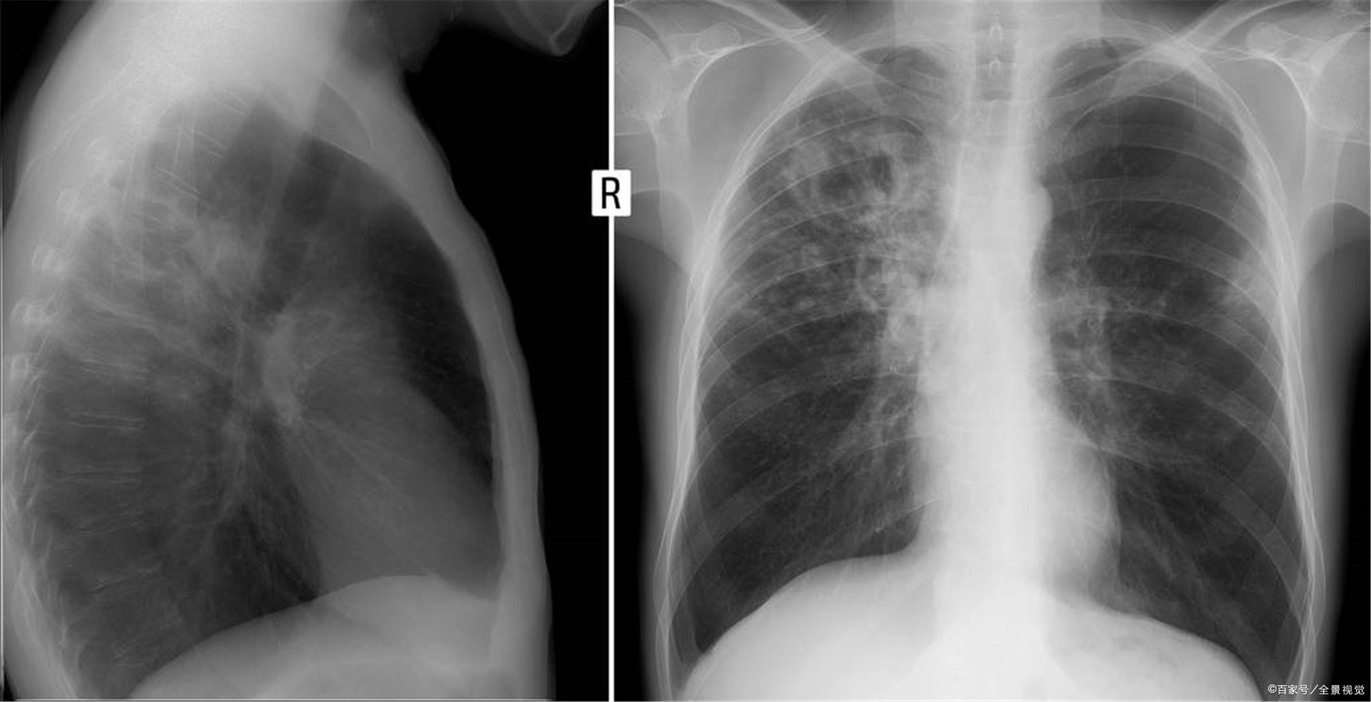 全国治疗肺结核最好的医院有哪几所?