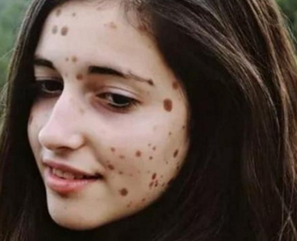 那个全身长着500多颗“斑点”的女孩，长大后怎样啦？