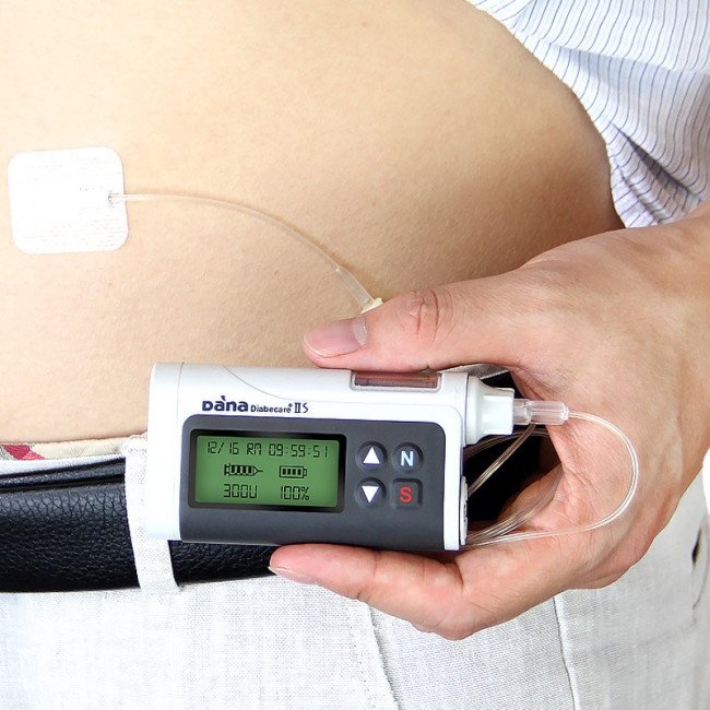 胰岛素泵价格是多少?