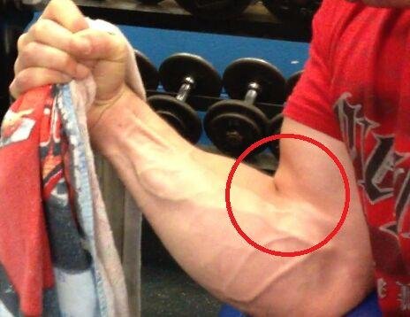 骨科医生掰手腕骨折给自己开药,哪些行为和动作容易造成骨折?