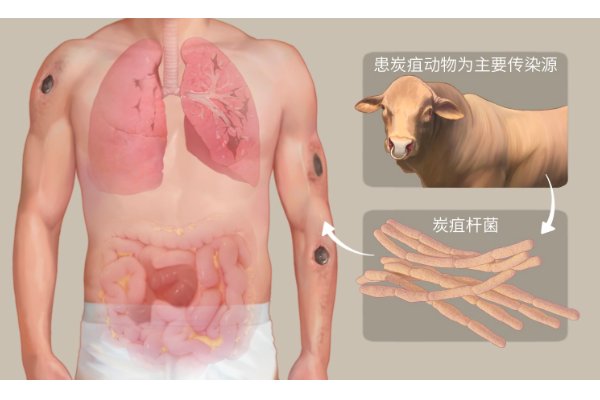 炭疽的读音是什么